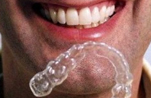 invisalign