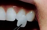 dental veneers